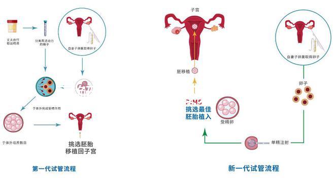了解二代試管嬰兒：技術(shù)原理與優(yōu)勢解析