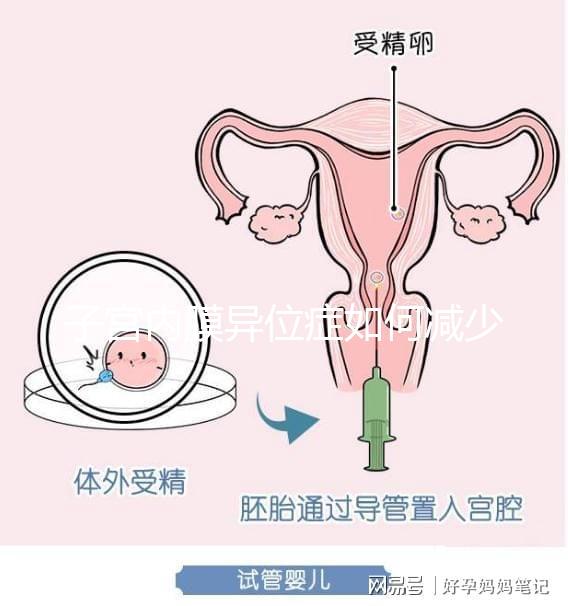 子宮內(nèi)膜異位癥如何減少手術次數(shù),增加試管嬰兒成功率?